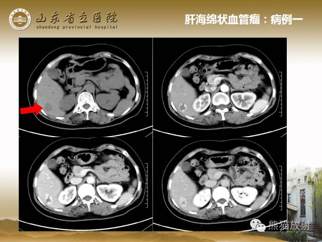 【PPT】肝脏影像学培训内容