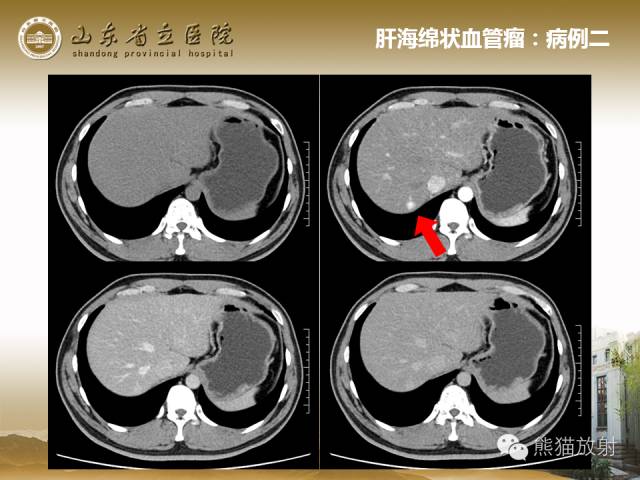 【PPT】肝脏影像学培训内容