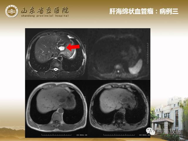 【PPT】肝脏影像学培训内容