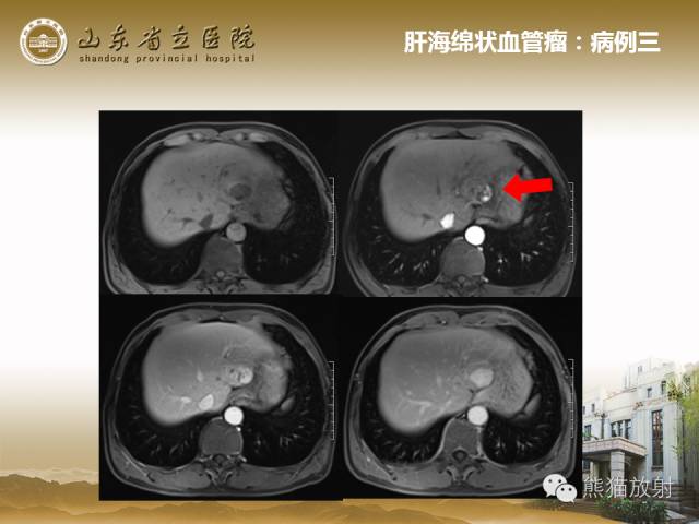 【PPT】肝脏影像学培训内容