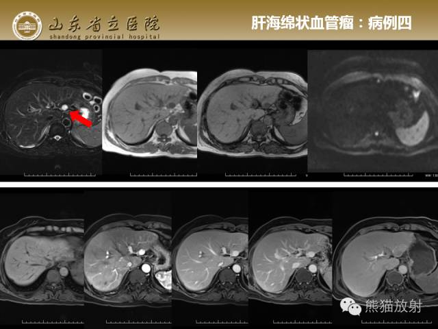 【PPT】肝脏影像学培训内容