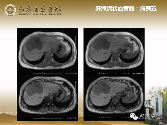【PPT】肝脏影像学培训内容