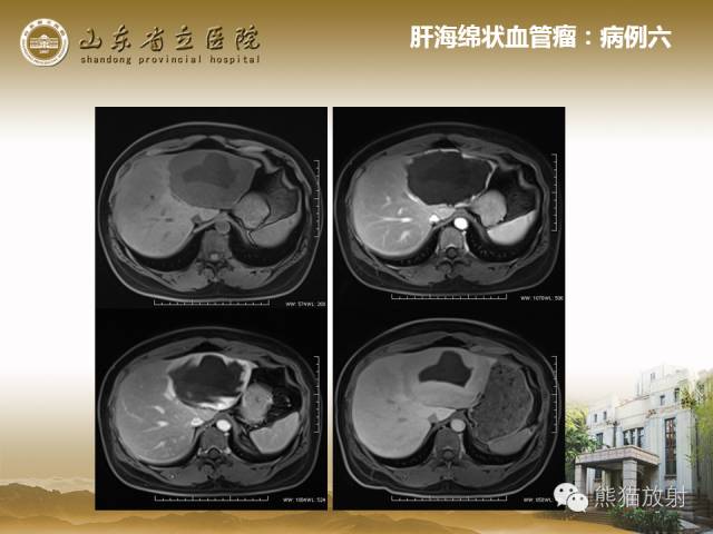 【PPT】肝脏影像学培训内容