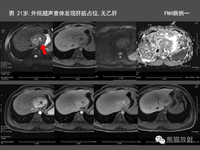 【PPT】肝脏影像学培训内容