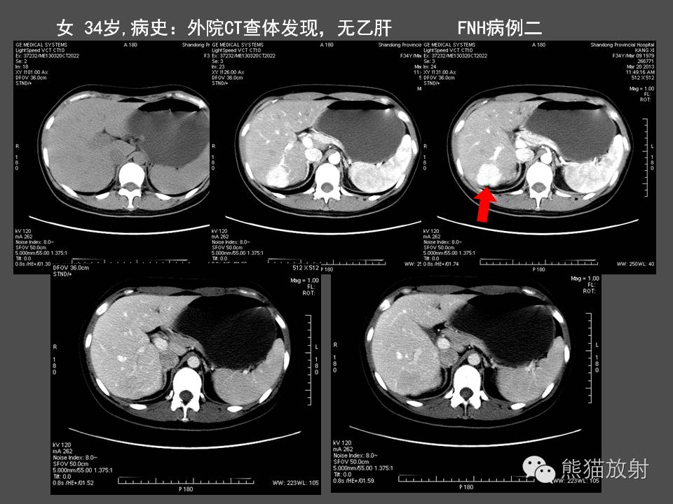 【PPT】肝脏影像学培训内容