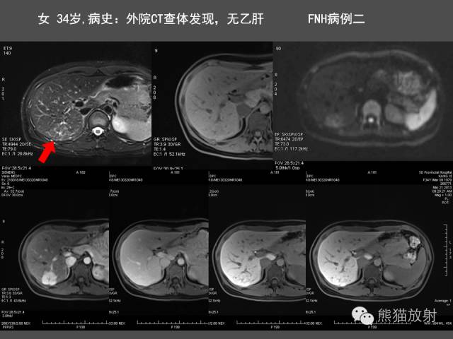 【PPT】肝脏影像学培训内容