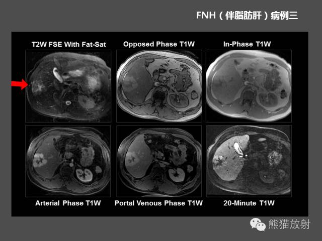 【PPT】肝脏影像学培训内容