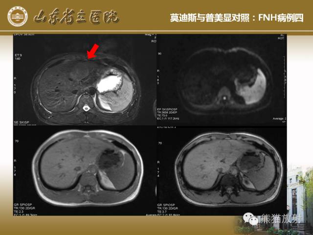 【PPT】肝脏影像学培训内容