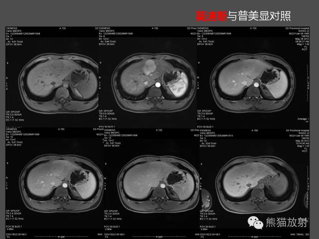 【PPT】肝脏影像学培训内容