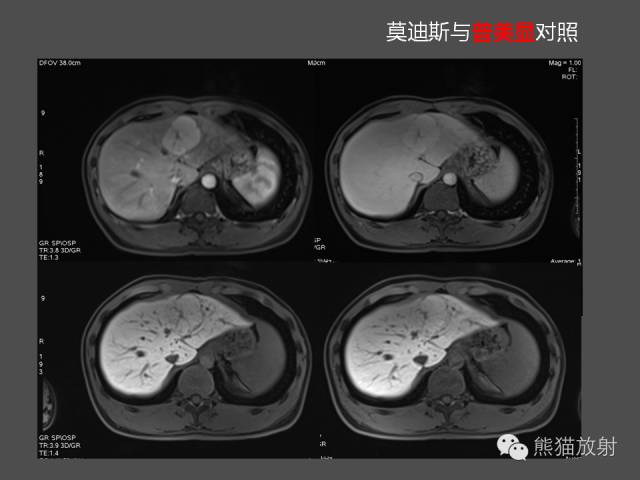 【PPT】肝脏影像学培训内容