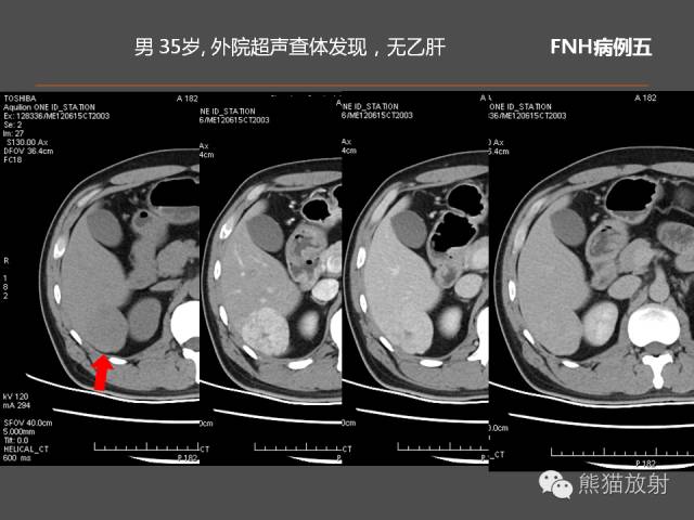 【PPT】肝脏影像学培训内容