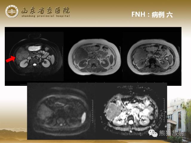 【PPT】肝脏影像学培训内容
