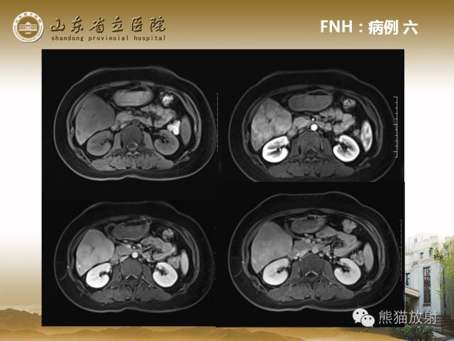 【PPT】肝脏影像学培训内容