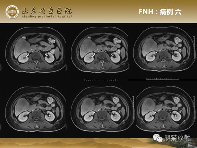 【PPT】肝脏影像学培训内容