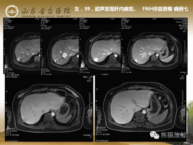 【PPT】肝脏影像学培训内容