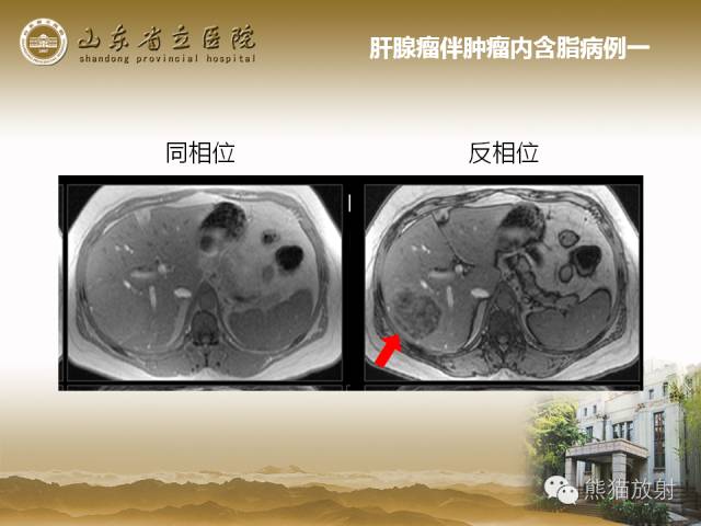 【PPT】肝脏影像学培训内容
