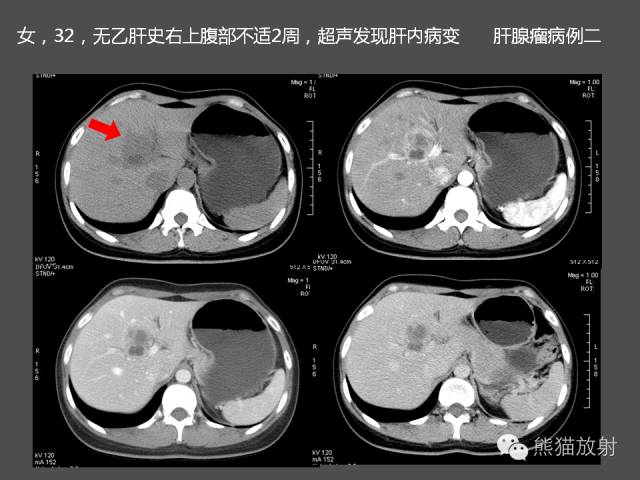 【PPT】肝脏影像学培训内容