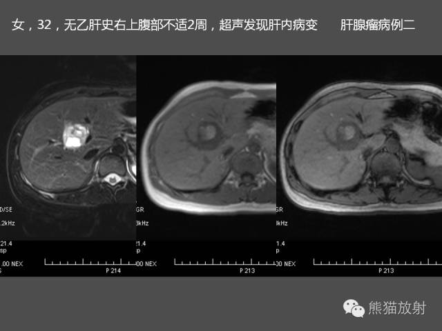 【PPT】肝脏影像学培训内容