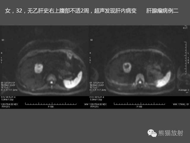 【PPT】肝脏影像学培训内容