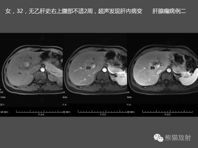 【PPT】肝脏影像学培训内容