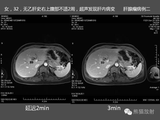 【PPT】肝脏影像学培训内容