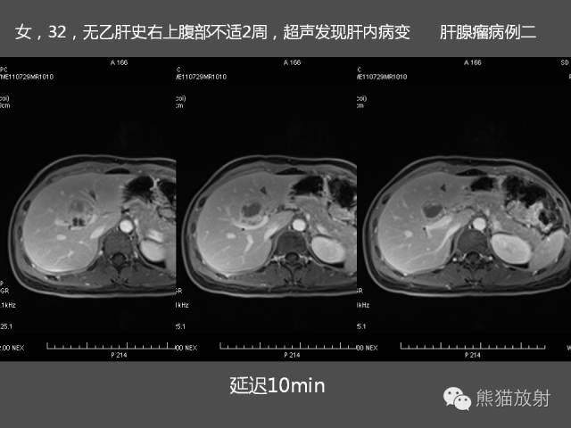 【PPT】肝脏影像学培训内容