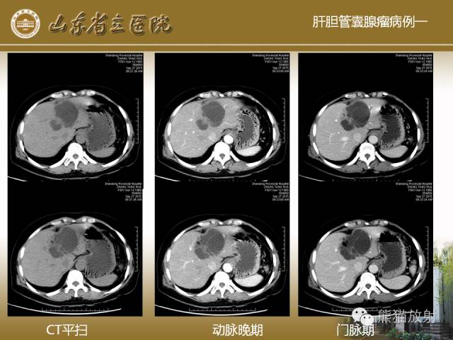 【PPT】肝脏影像学培训内容
