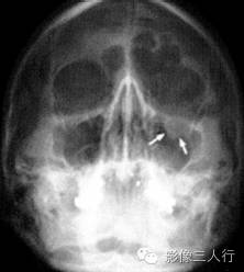 "泪滴征"，这个征象提示啥？
