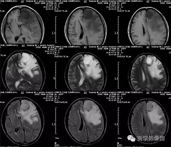 【病例】血管瘤型脑膜瘤1例MR影像表现 【病例】血管瘤型脑膜瘤1例MR影像表现