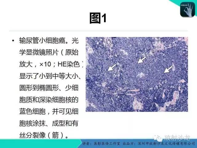 【PPT】肺外小细胞癌 影像学特点及影像-病理对照