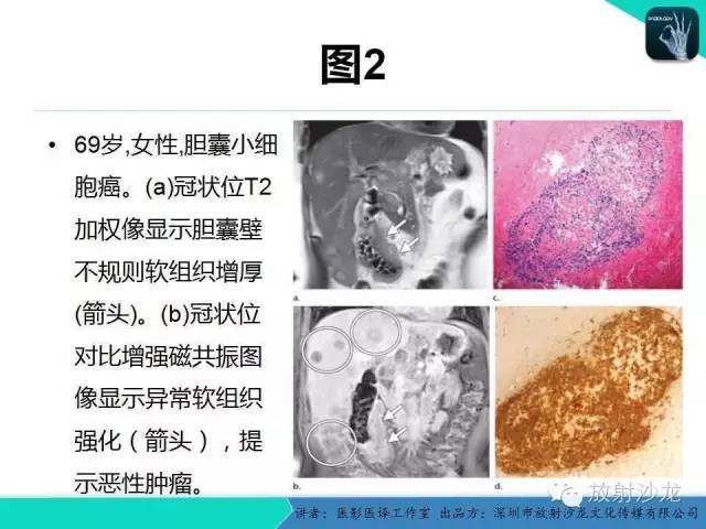 【PPT】肺外小细胞癌 影像学特点及影像-病理对照