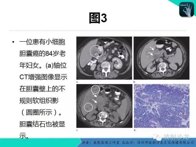 【PPT】肺外小细胞癌 影像学特点及影像-病理对照