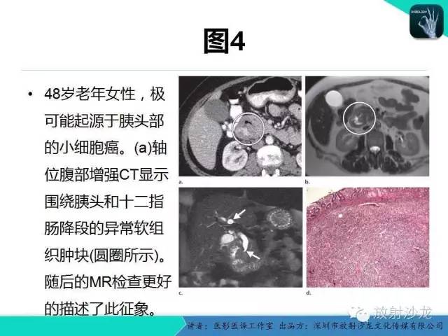 【PPT】肺外小细胞癌 影像学特点及影像-病理对照