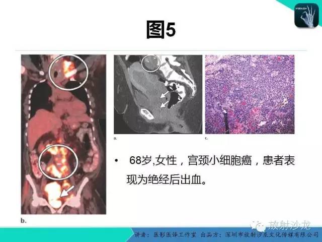 【PPT】肺外小细胞癌 影像学特点及影像-病理对照