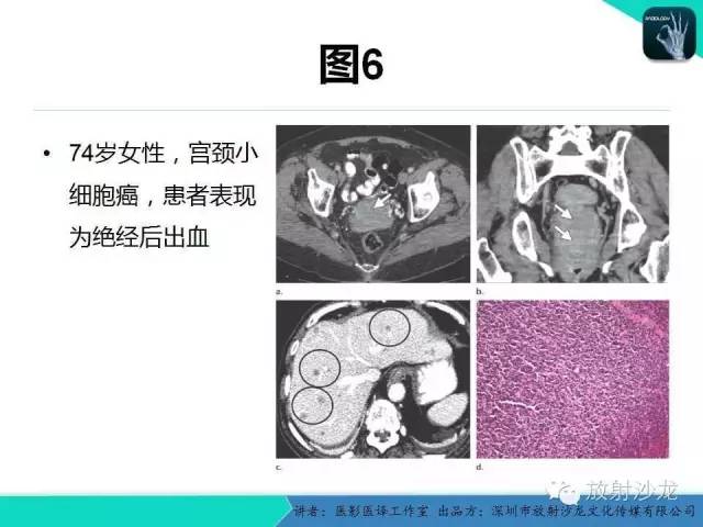 【PPT】肺外小细胞癌 影像学特点及影像-病理对照