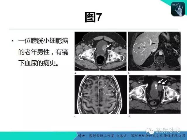 【PPT】肺外小细胞癌 影像学特点及影像-病理对照