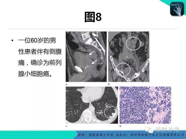 【PPT】肺外小细胞癌 影像学特点及影像-病理对照