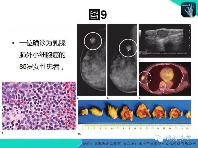 【PPT】肺外小细胞癌 影像学特点及影像-病理对照