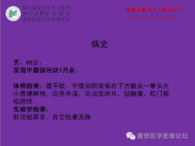 【病例】空肠系膜淋巴瘤1例CT影像表现