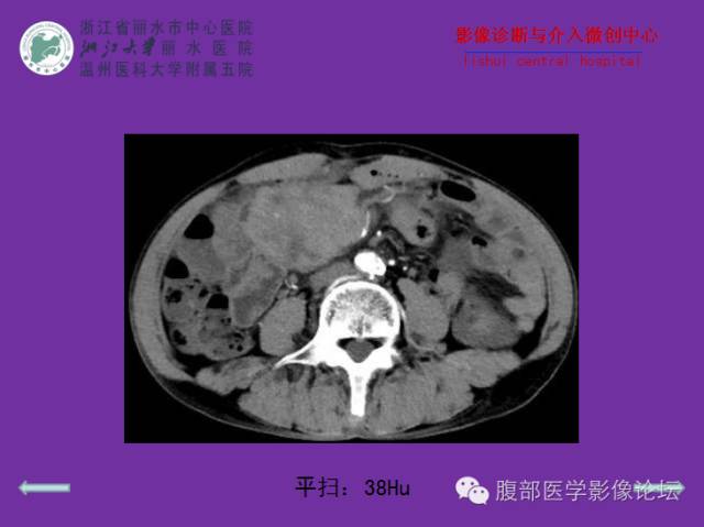 【病例】空肠系膜淋巴瘤1例CT影像表现 【病例】空肠系膜淋巴瘤1例CT影像表现