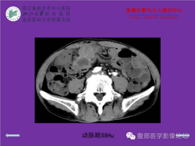 【病例】空肠系膜淋巴瘤1例CT影像表现 【病例】空肠系膜淋巴瘤1例CT影像表现