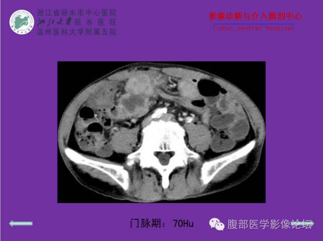 【病例】空肠系膜淋巴瘤1例CT影像表现 【病例】空肠系膜淋巴瘤1例CT影像表现