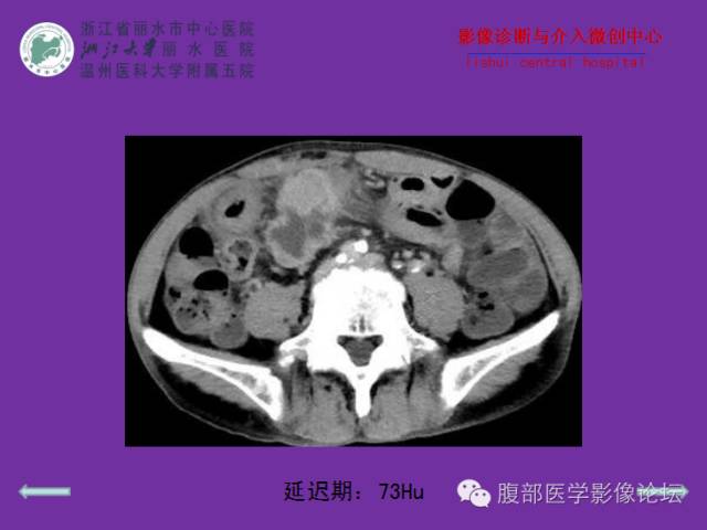 【病例】空肠系膜淋巴瘤1例CT影像表现 【病例】空肠系膜淋巴瘤1例CT影像表现