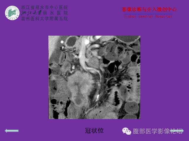 【病例】空肠系膜淋巴瘤1例CT影像表现 【病例】空肠系膜淋巴瘤1例CT影像表现