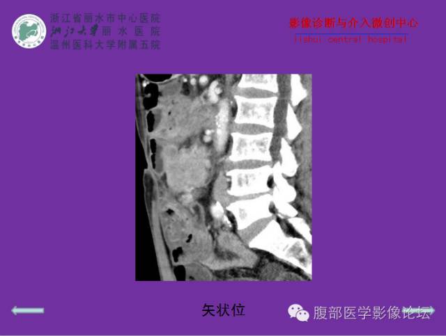【病例】空肠系膜淋巴瘤1例CT影像表现 【病例】空肠系膜淋巴瘤1例CT影像表现