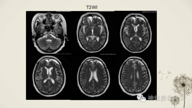 【病例】渗透性脱髓鞘综合征1例MR影像表现与鉴别