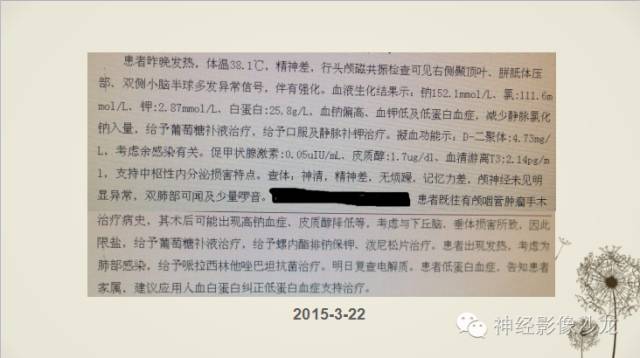 【病例】渗透性脱髓鞘综合征1例MR影像表现与鉴别