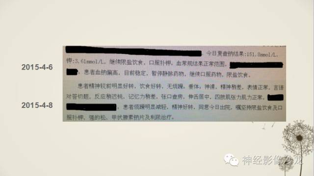【病例】渗透性脱髓鞘综合征1例MR影像表现与鉴别