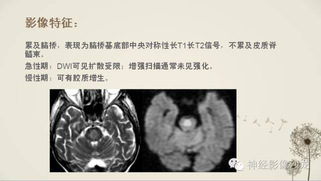 【病例】渗透性脱髓鞘综合征1例MR影像表现与鉴别
