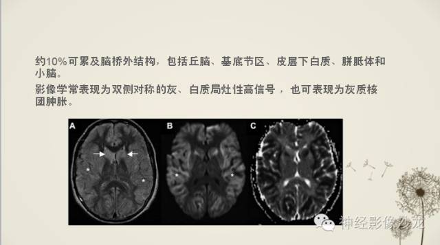 【病例】渗透性脱髓鞘综合征1例MR影像表现与鉴别